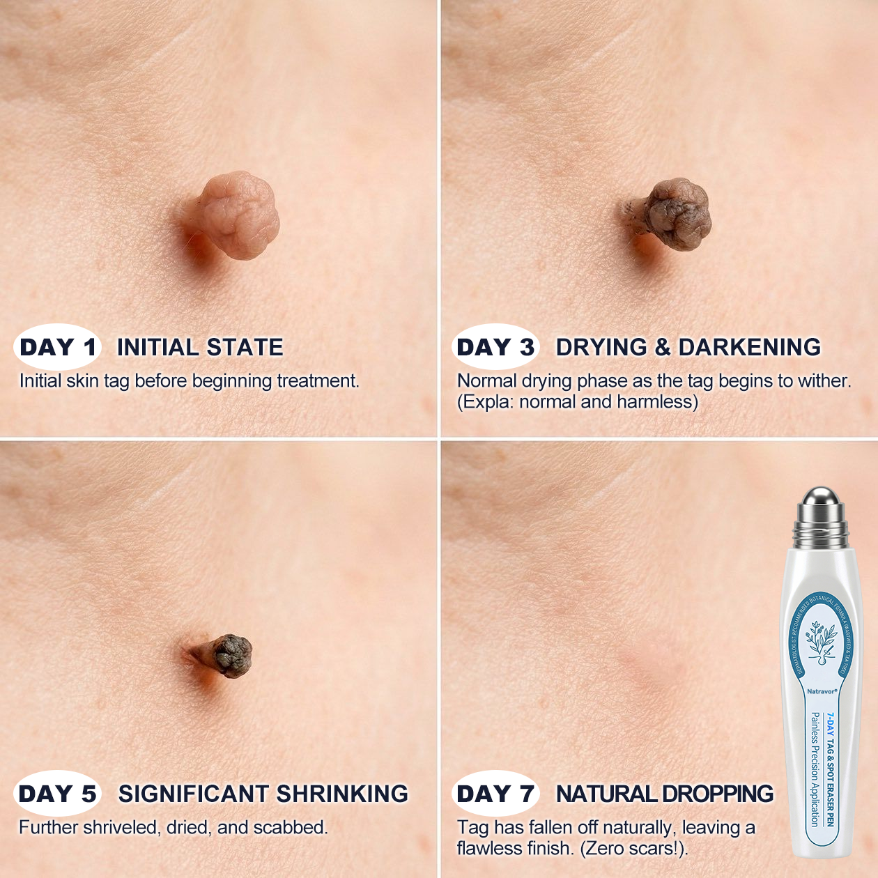 🔥 Today Only: Get 50% Off Your Second Item |✅🎉Natravor® 7-𝐷𝑎𝑦 𝗧𝐚𝐠 & 𝗦𝗽𝐨𝐭 𝐄𝐫𝒂𝒔𝒆𝒓(Zero Pain, Zero 𝐒𝐜𝐚𝒓𝒔 Rollerball)